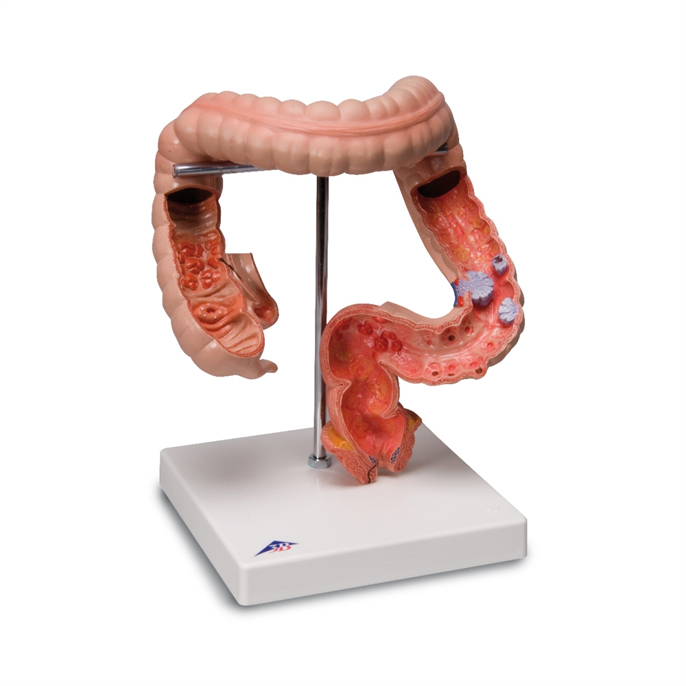Gastric Diseases Model